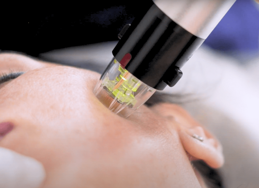 Laser_Genius_cicatrices_acne_visage